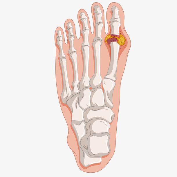 手绘卡通骨折示意图