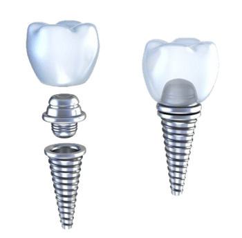 种植牙补牙