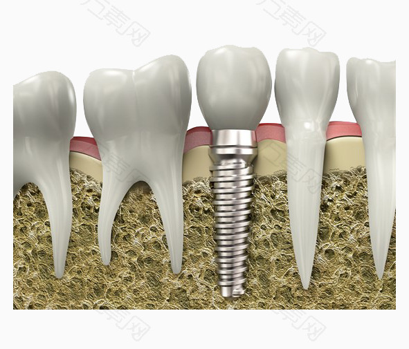 種植牙齒圖片素材